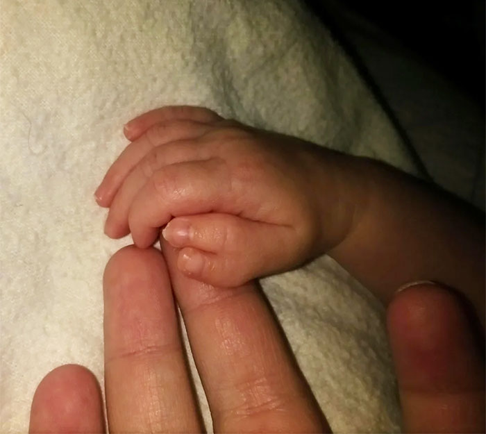 My Daughter Was Born Polydactyl On One Hand With Two Thumbs. I Think It's Rad