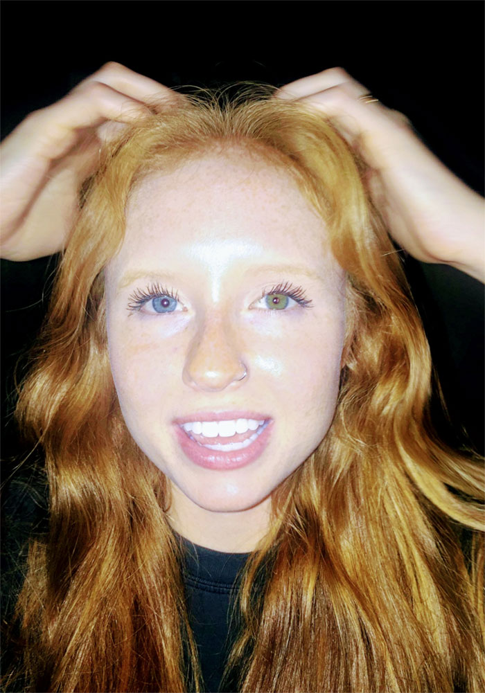 My Sister Is A Ginger And Has Heterochromia. A Genetic Masterpiece