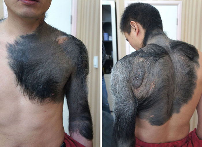 Zhang Hongming Suffers From Rare Congenital Giant Pigmented Nevus, Commonly Know As Giant Furred Moles