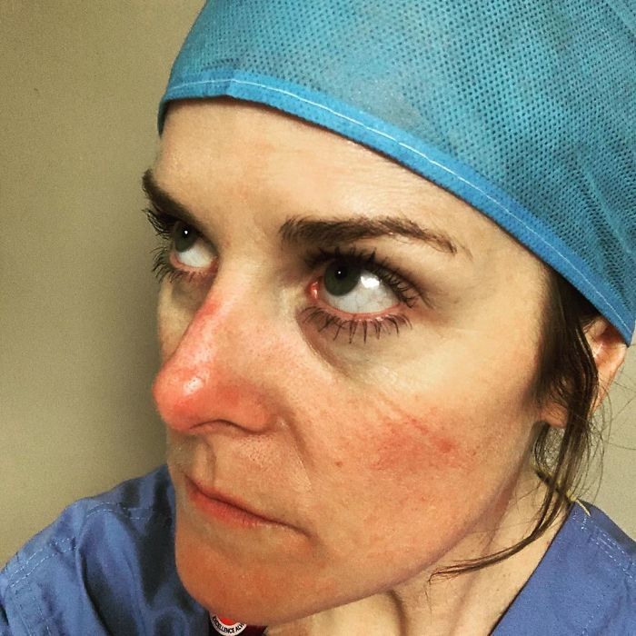 Nurse Shows What She Calls Her "Battle Scars"