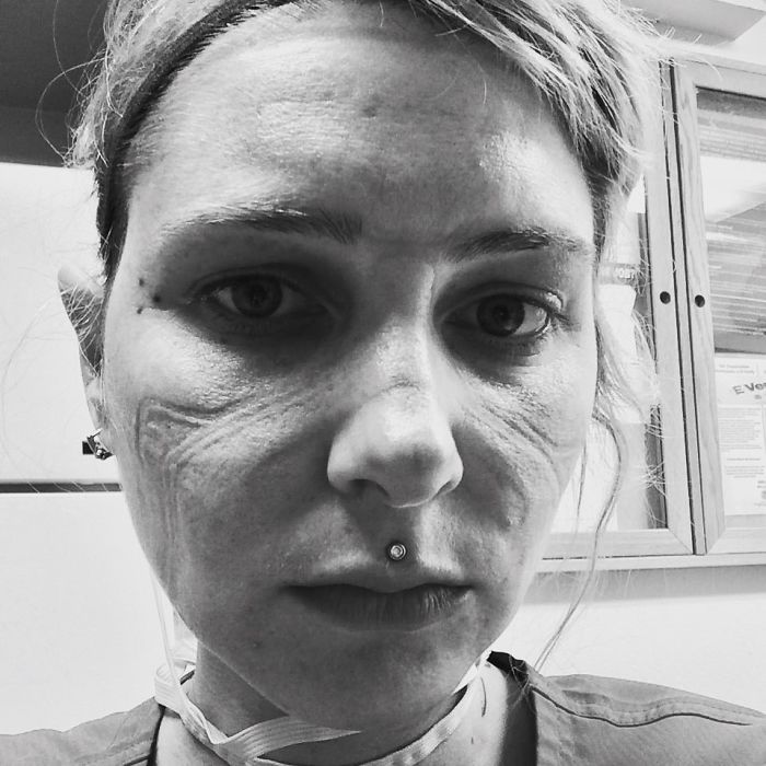 "Another Day In Paradise" - Healthcare Worker Showcases The Marks Left By The Ppe