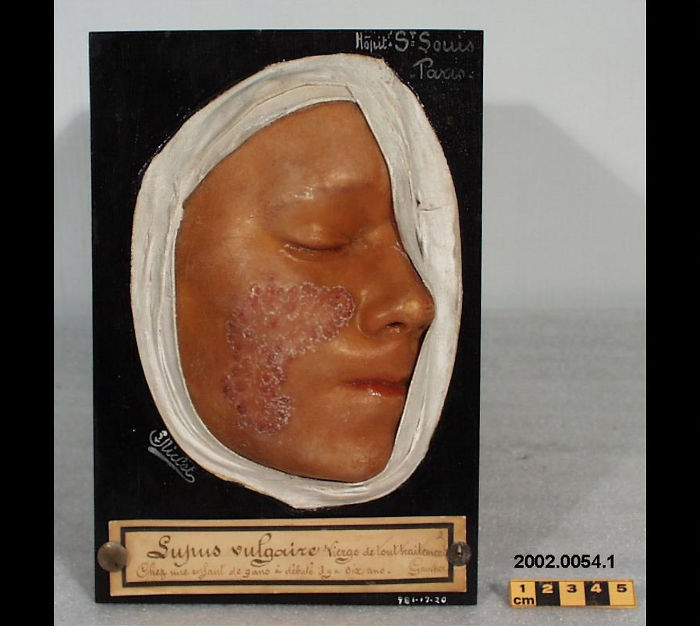 Wax Model Used Around 1900 To Show What Different Skin Lesions Look Like