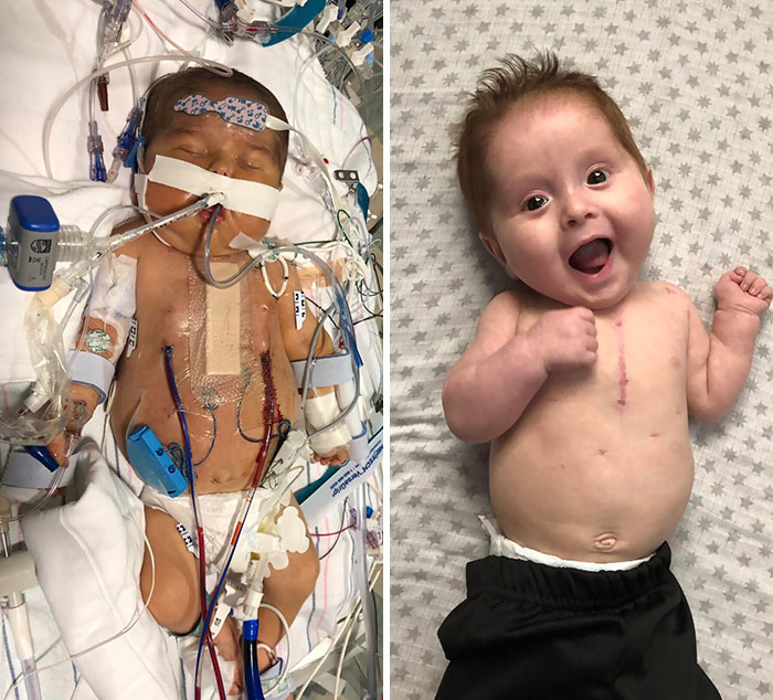 The Docs Gave My Son A 10% Chance To Survive His CHD. He Is 6 Months Old Today And Thriving
