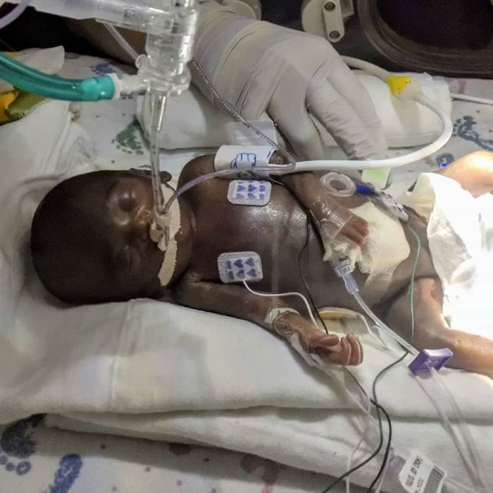 "I Adopted A 'Perfect' Micro-Preemie & Was By His Side As He Died 8 Days Later"
