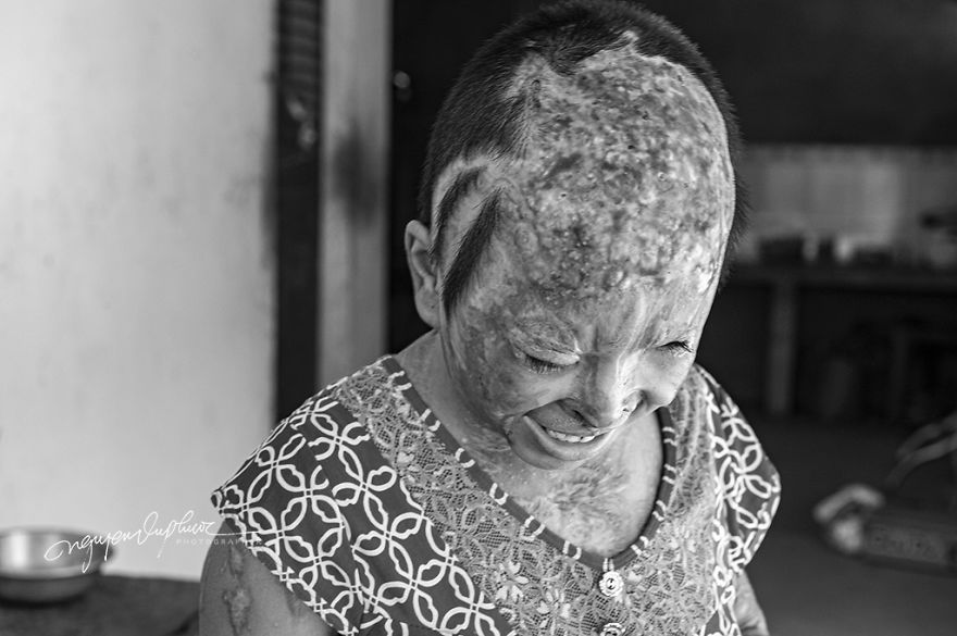 Abandoned Child Faces Gloomy Future Because Of Acid Attack