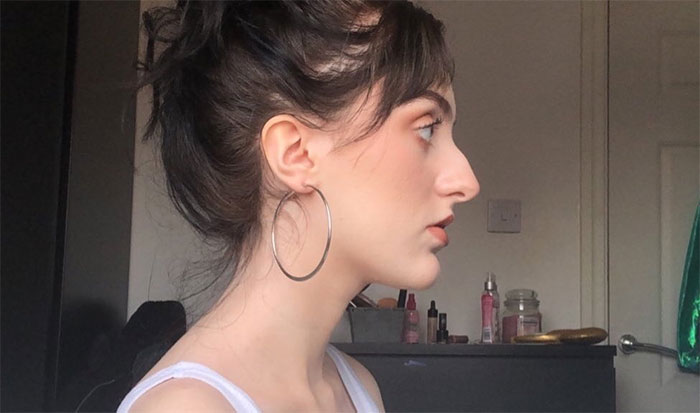 Women Are Posting Their Noses That Look Like “Before” Photos