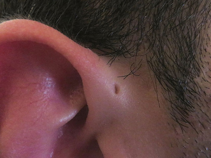 La gente se da cuenta de que estos agujeritos sobre sus orejas pueden tener una explicación evolutiva