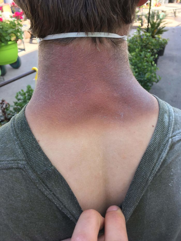 Don't Forget To Use Sunscreen