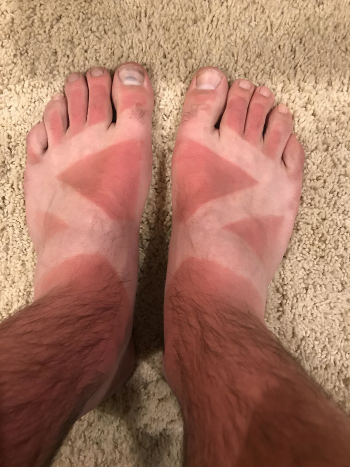 I Got Drunk And Forgot To Put Sunscreen On My Feet