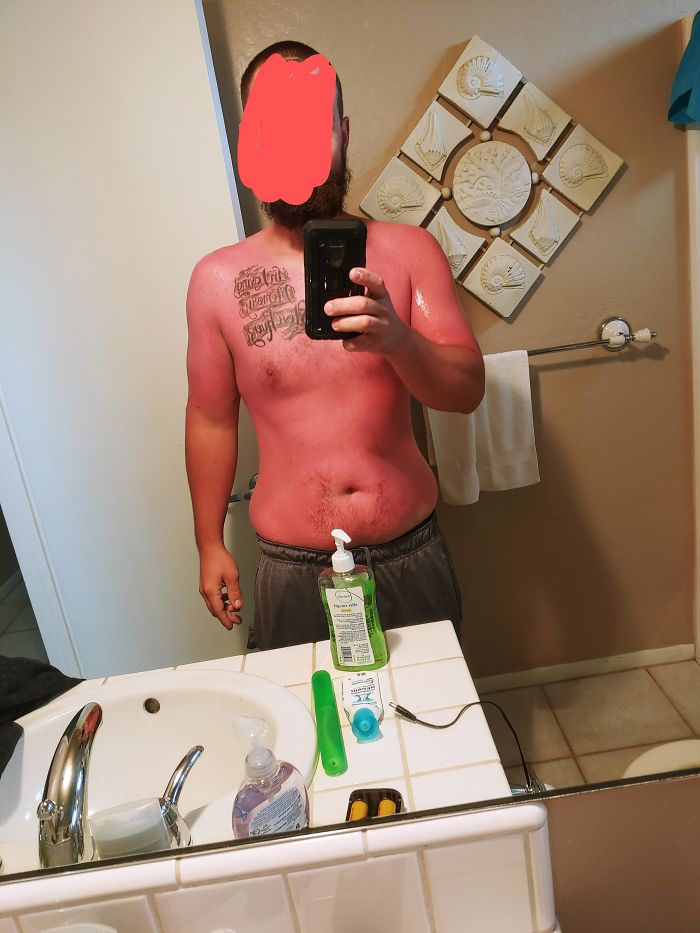 When You Are From Arizona And Think 70 Degrees On The Beach In Cali Doesn't Require Sunscreen. I. Hurt