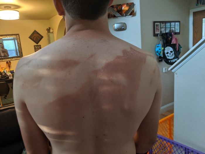 Stubborn Husband Said He Didn't Need My Help Putting Sunscreen On His Back