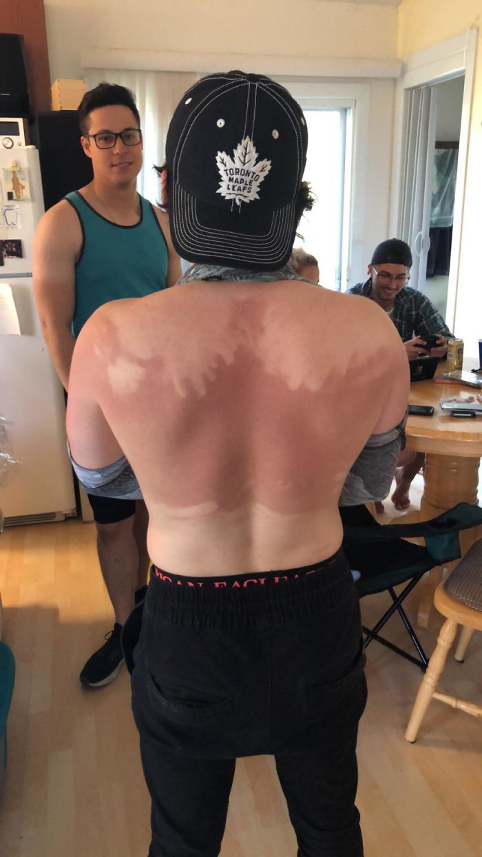 My Friend Refused To Ask For Help With Putting Sunscreen On, This Is The Result