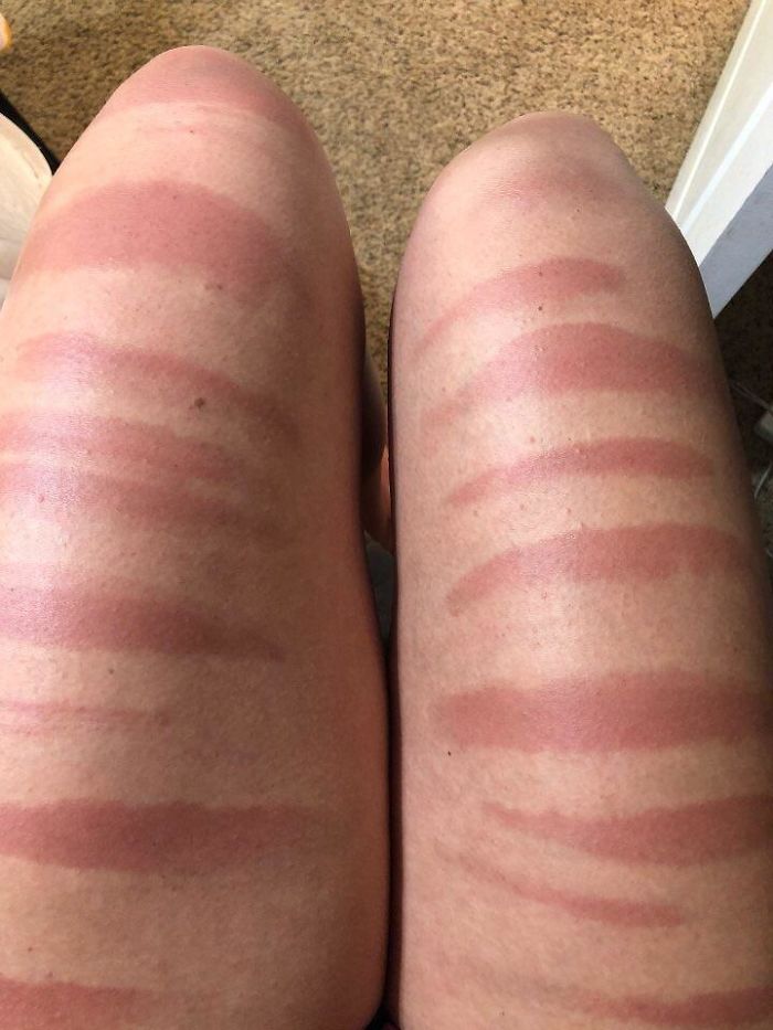 My Cousin’s Legs After A Day In The Sun In Ripped Jeans