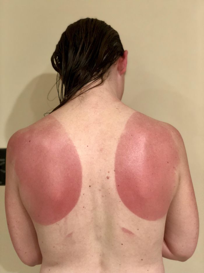 This Is What Happens When You Go On A Bike Ride When It’s 100 Degrees Outside Without The Proper Sunscreen