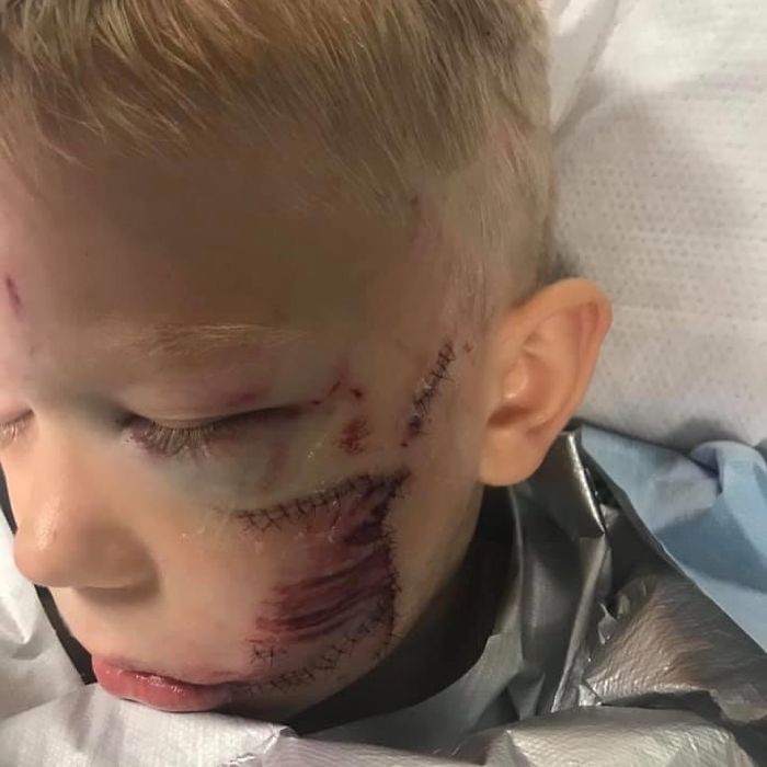 6-Year-Old Superhero Saves Sister From Dog Attack, Gets 90 Stitches And Praise From The Avengers