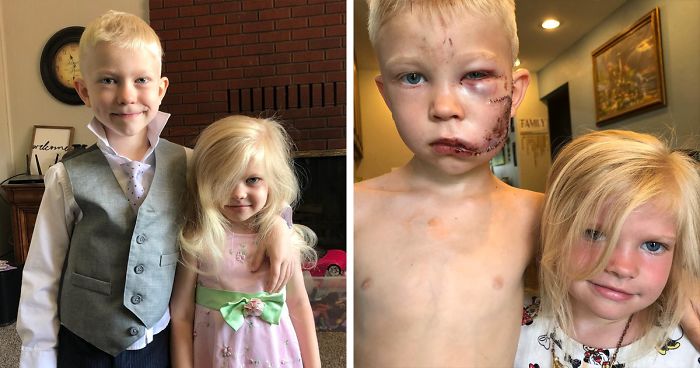 6-Year-Old Superhero Saves Sister From Dog Attack, Gets 90 Stitches And  Praise From The Avengers | Bored Panda