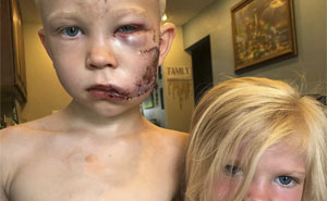 6-Year-Old Superhero Saves Sister From Dog Attack, Gets 90 Stitches And Praise From The Avengers