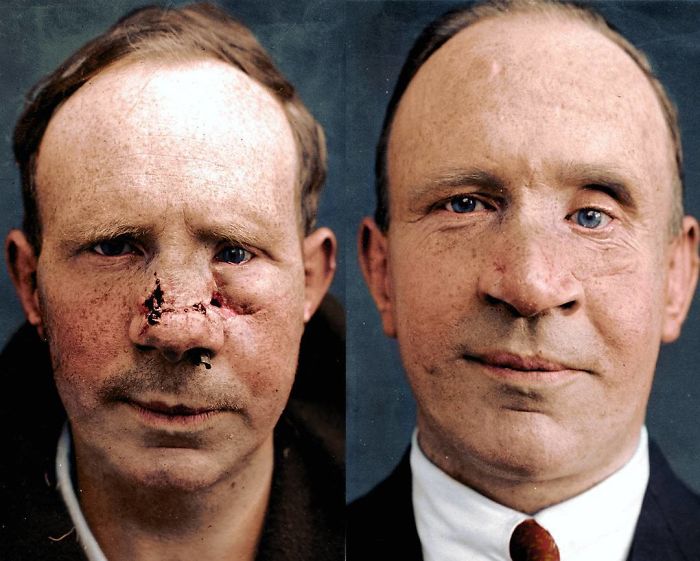 Frederick Charles Stacey Of The Royal Navy On Admission For Treatment For Wounds Sustained In Wwi, And Seen After The Successful Plastic Surgery.