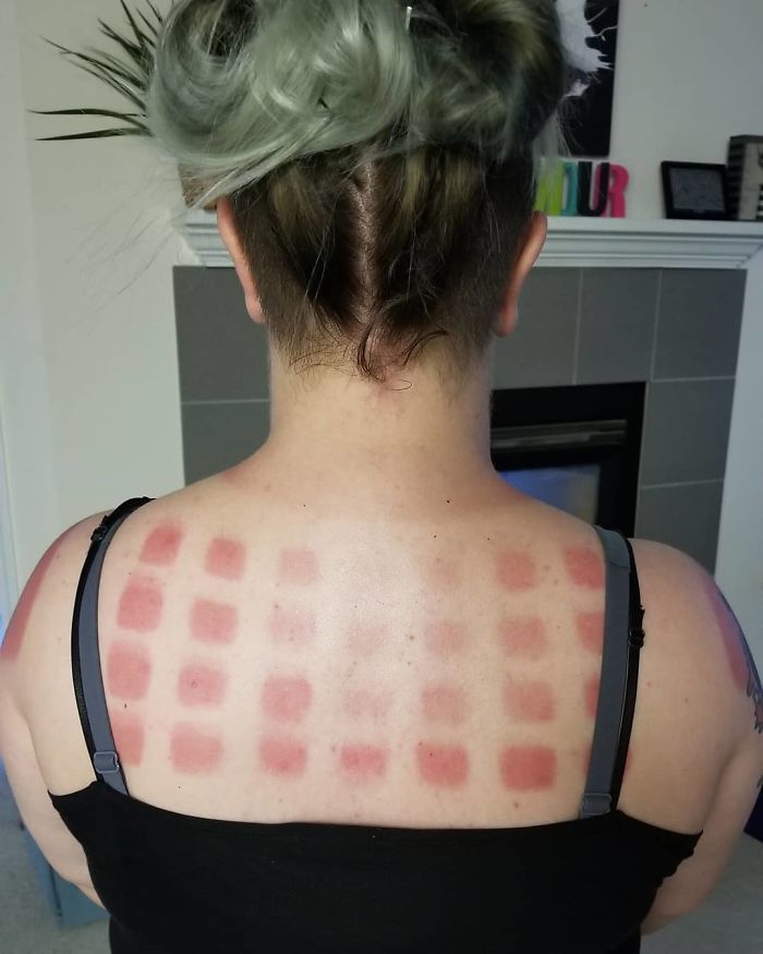 What Happens When You're Super White And You Walked Around All Day In A Shirt With Cutout Squares. And This Was With Multiple Applications Of Sunscreen