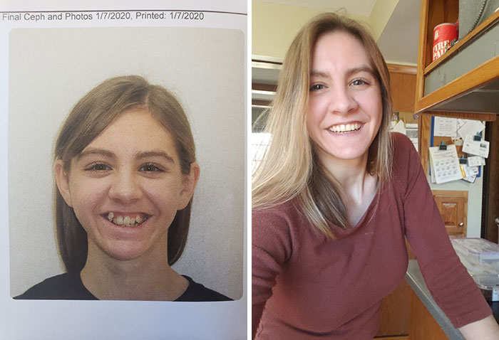Tras 9 años, al fin me han quitado la ortodoncia y no paro de sonreír