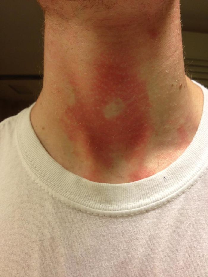 Apparently My Adam's Apple Provided Just Enough Shade To Prevent A Small Portion Of My Neck From Getting Sunburned