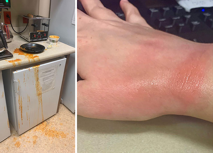 My Submission For Dumbest Way To Injure Yourself: I Burnt My Hand Taking Tomato Soup Out Of The Microwave. The Toast I Was Making Popped Up And It Scared Me