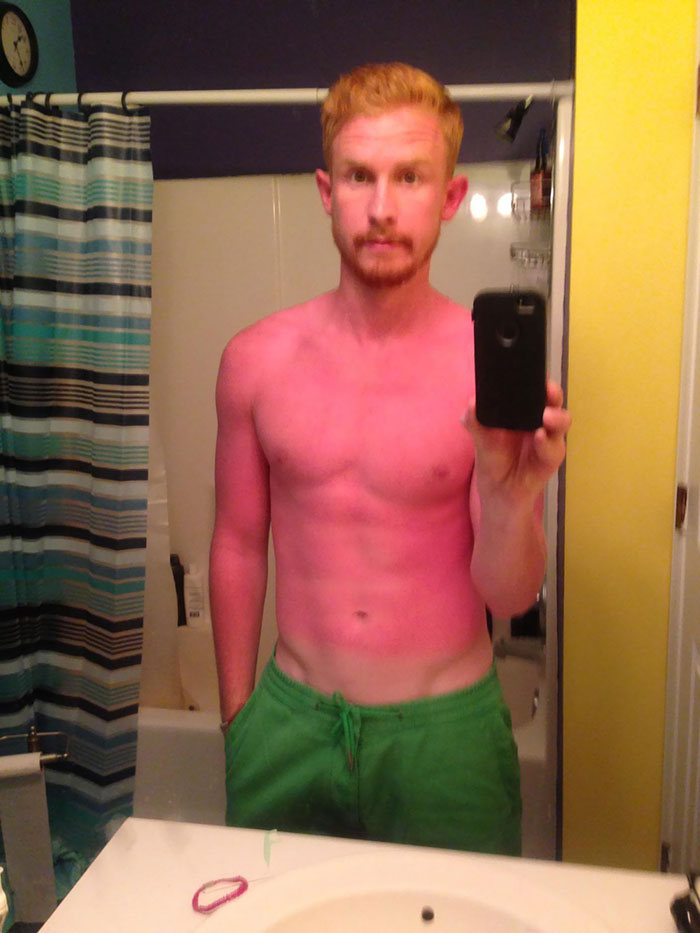 What Could Go Wrong If I Forget The Sunscreen?