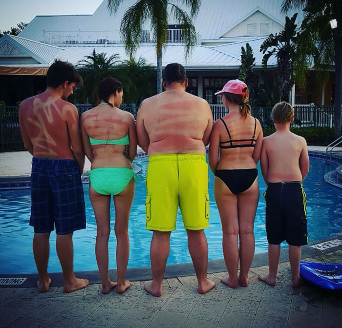 My Friends' First Time In The Florida Sun. Apparently It Was Also Their First Time Using A Spray-On Sunscreen