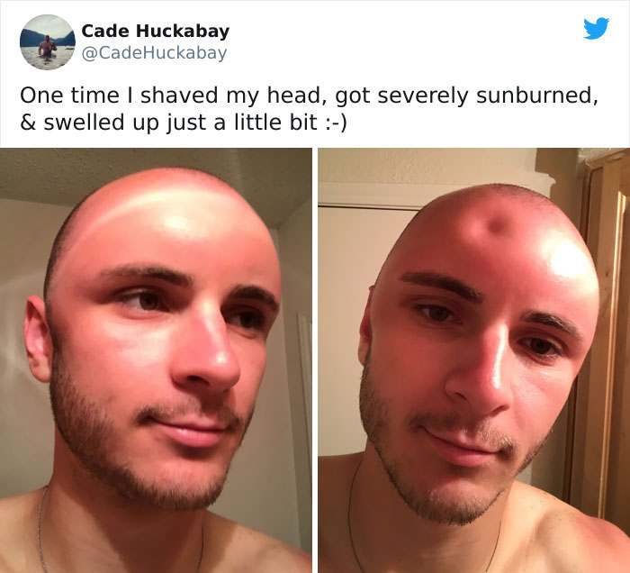 This Is Cade's Freshly Shaved Head After A Sunscreenless Few Hours Mowing A Field