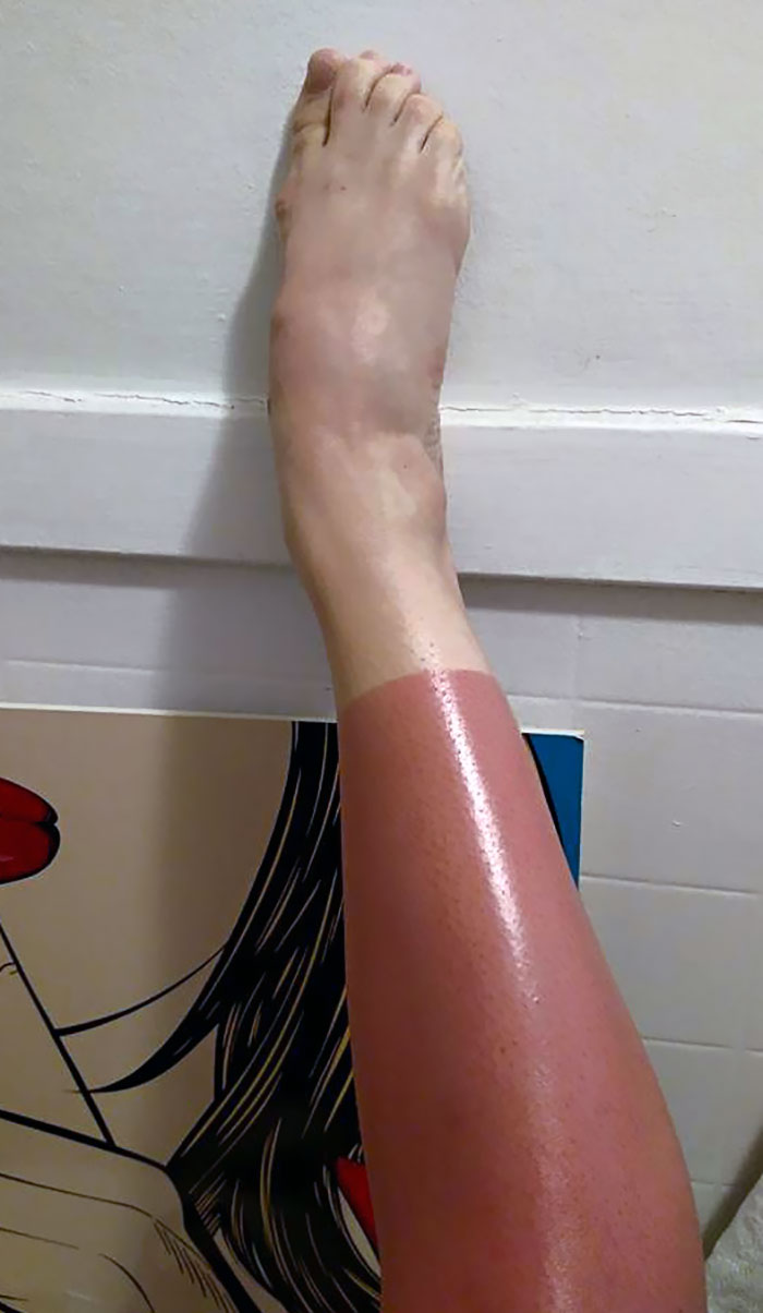 Perfect Sunburn Spotted In My Facebook Feed