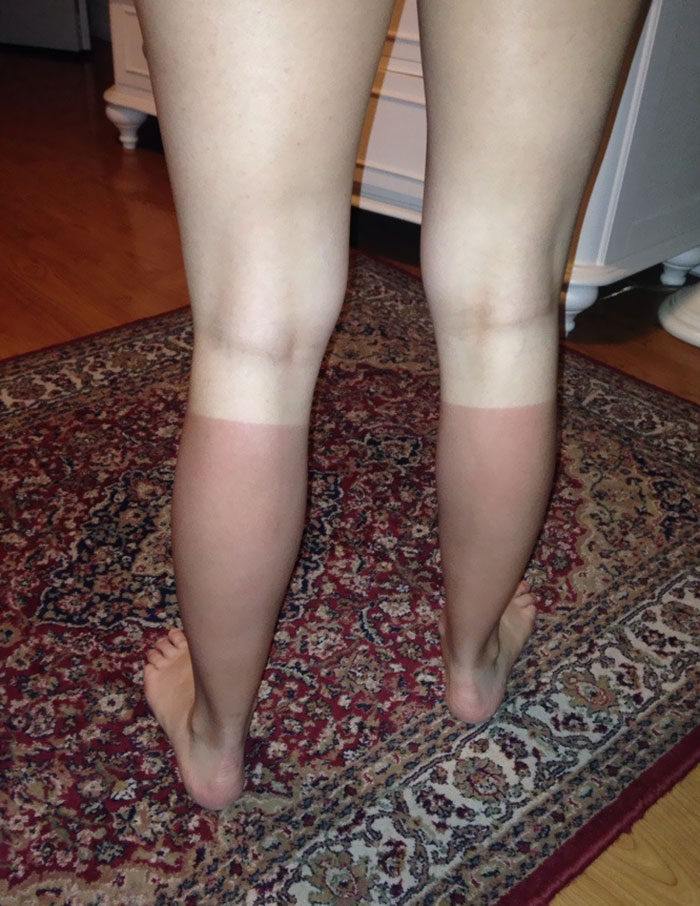 My Sister's Sunburn After A Day Of Outdoor Tournaments