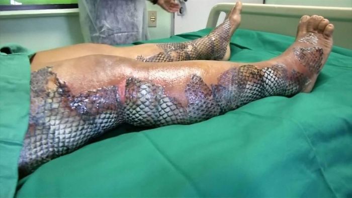 Certain Fish Skin Can Be Grafted Onto Burns And Diabetic Wounds. The Material Recruits The Body's Own Cells And Is Converted Eventually Into Living Tissue