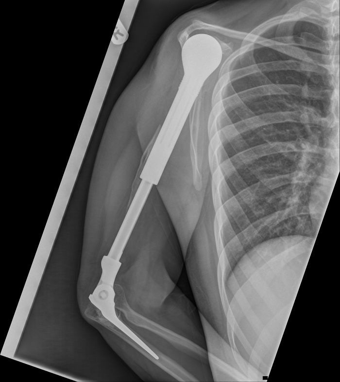 X-Ray Of My Metal Arm