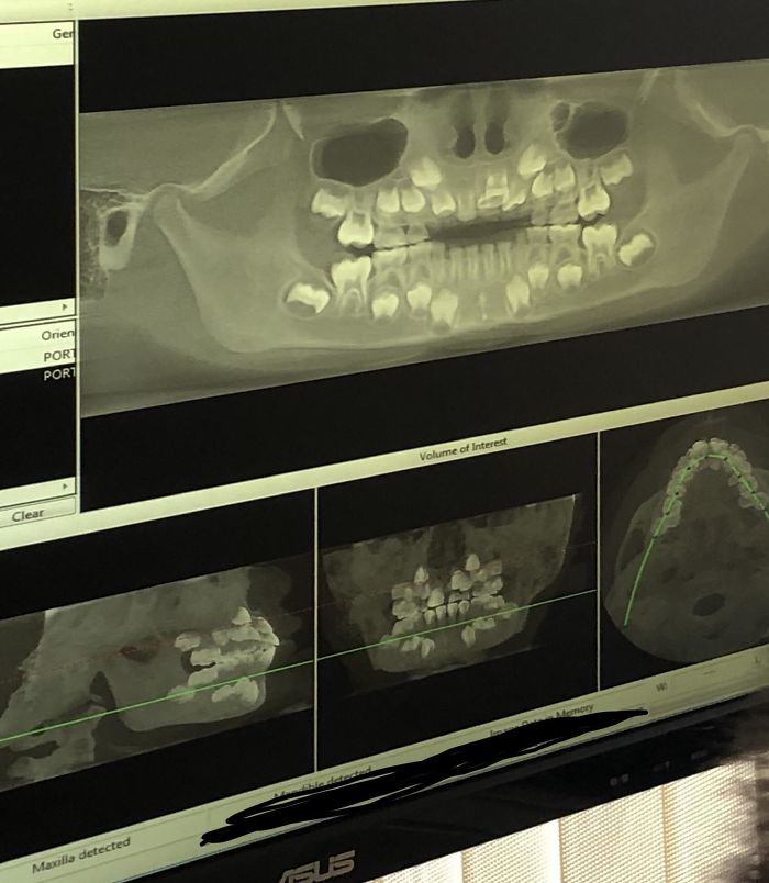 Dental 3D X-Ray On A Child