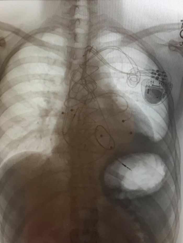My Chest X-Ray After 3 Pacemaker Surgeries, A Median Sternotomy And Valve Repair