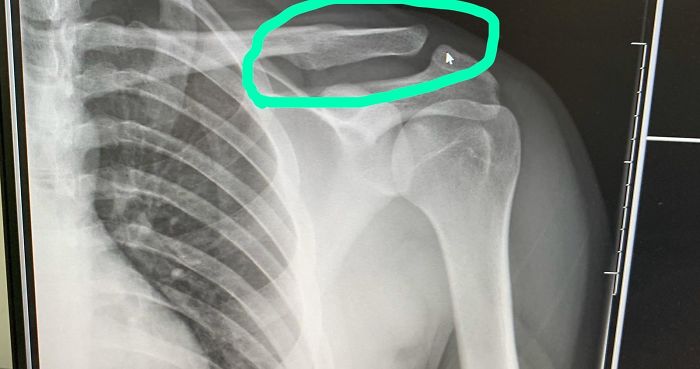 Went Through 21 Years Thinking I Never Broke A Bone Until An X-Ray For A Shoulder Problem Revealed This Atrocity, It Broke And Healed Without Me Knowing, Was Nice Knowing You