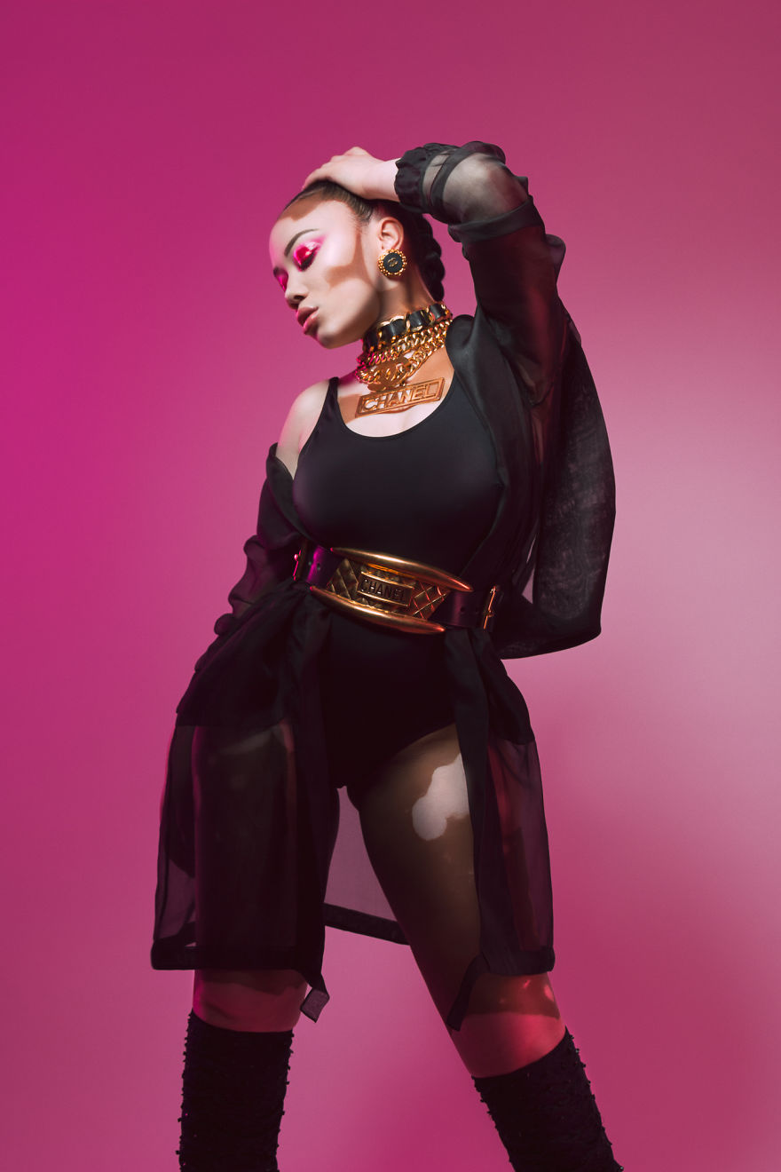 I Did A Photoshoot To Show The Beauty Of Vitiligo I Did A Photoshoot To Show The Beauty Of Vitiligo