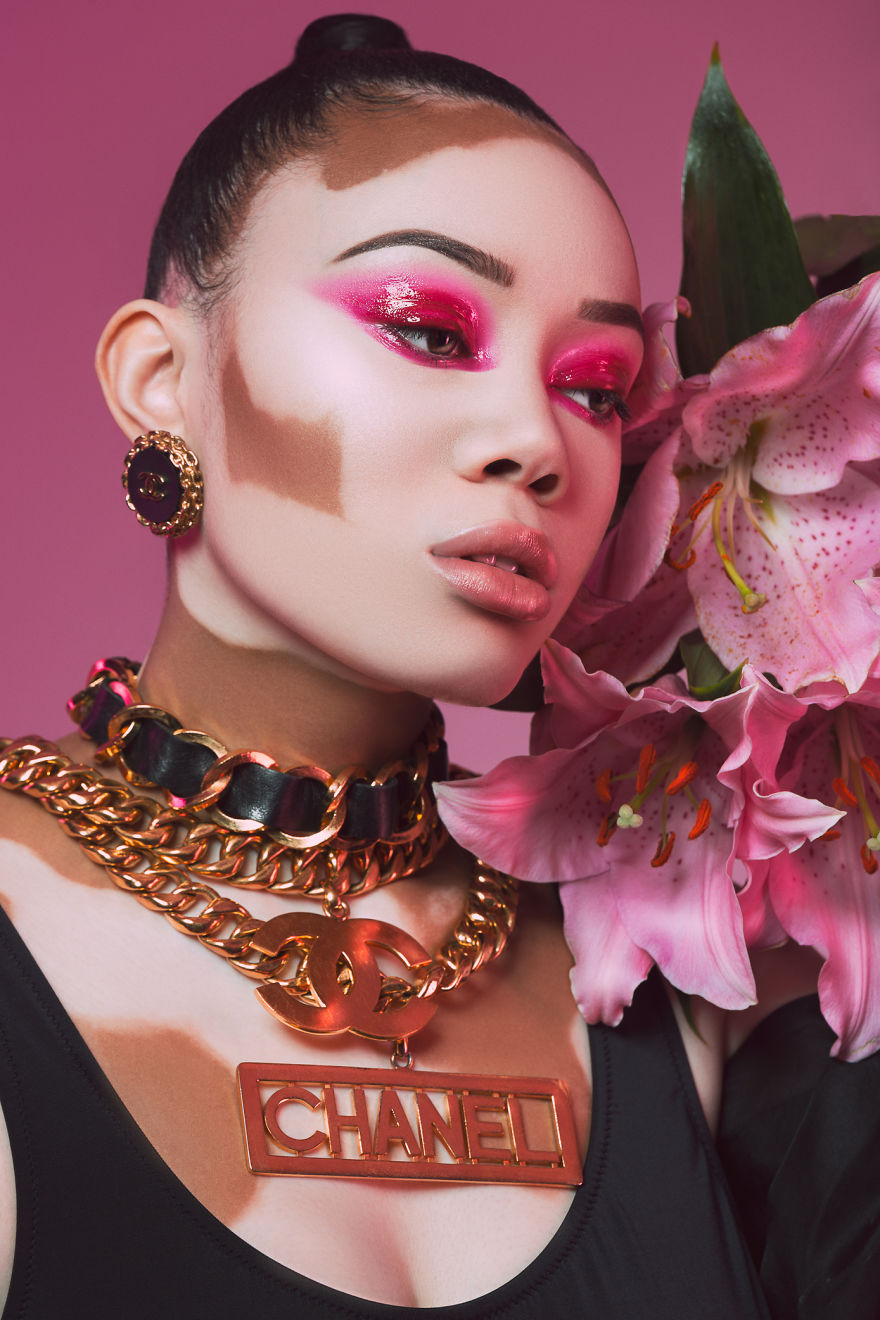 I Did A Photoshoot To Show The Beauty Of Vitiligo I Did A Photoshoot To Show The Beauty Of Vitiligo