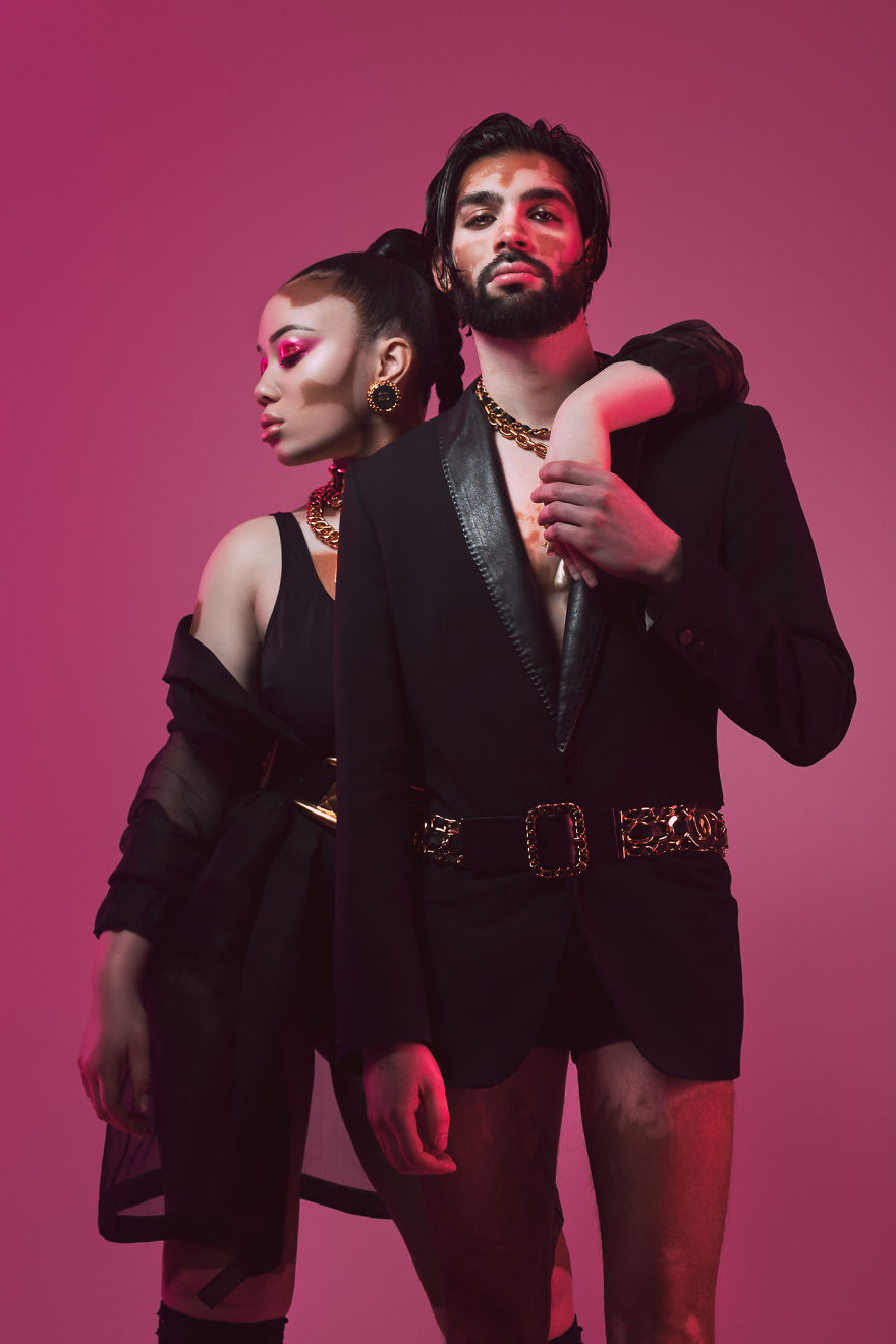I Did A Photoshoot To Show The Beauty Of Vitiligo I Did A Photoshoot To Show The Beauty Of Vitiligo