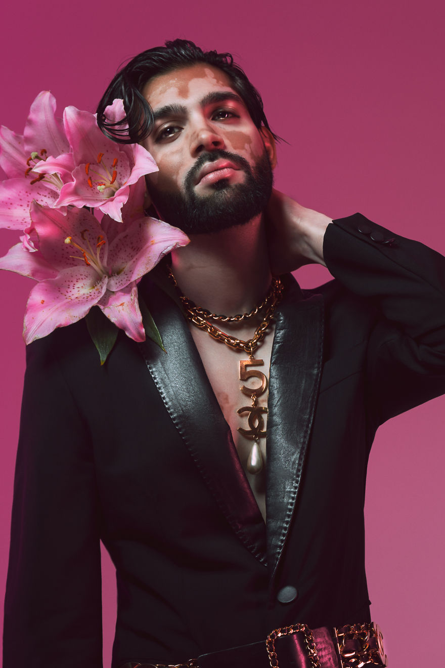 I Did A Photoshoot To Show The Beauty Of Vitiligo I Did A Photoshoot To Show The Beauty Of Vitiligo