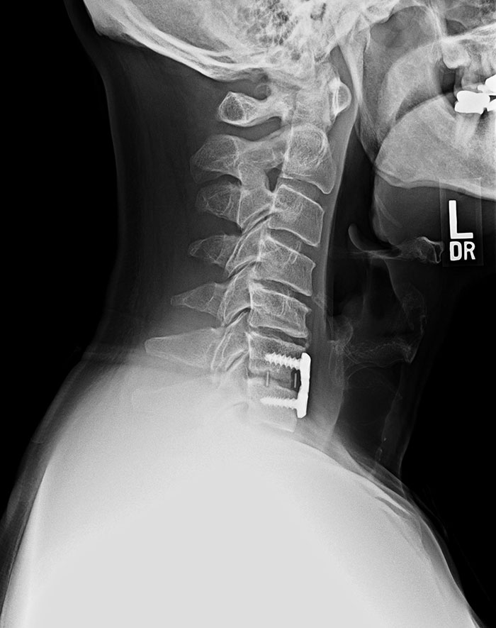 This Is An X-Ray Of The Device Doctors Put In My Dad's Neck, Containing Undeveloped Bone Cells And Stem Cells To Regrow Parts Of His Spine. Science