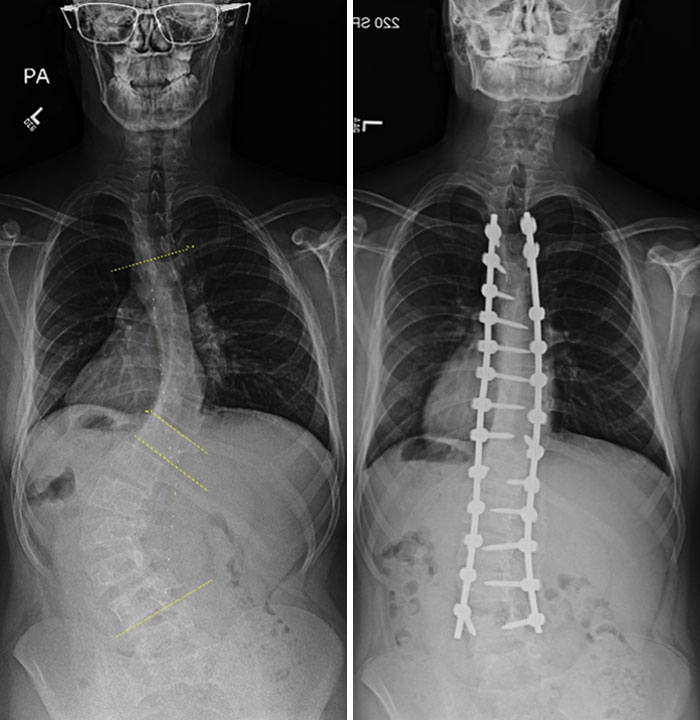 Scoliosis Surgery, Before And After