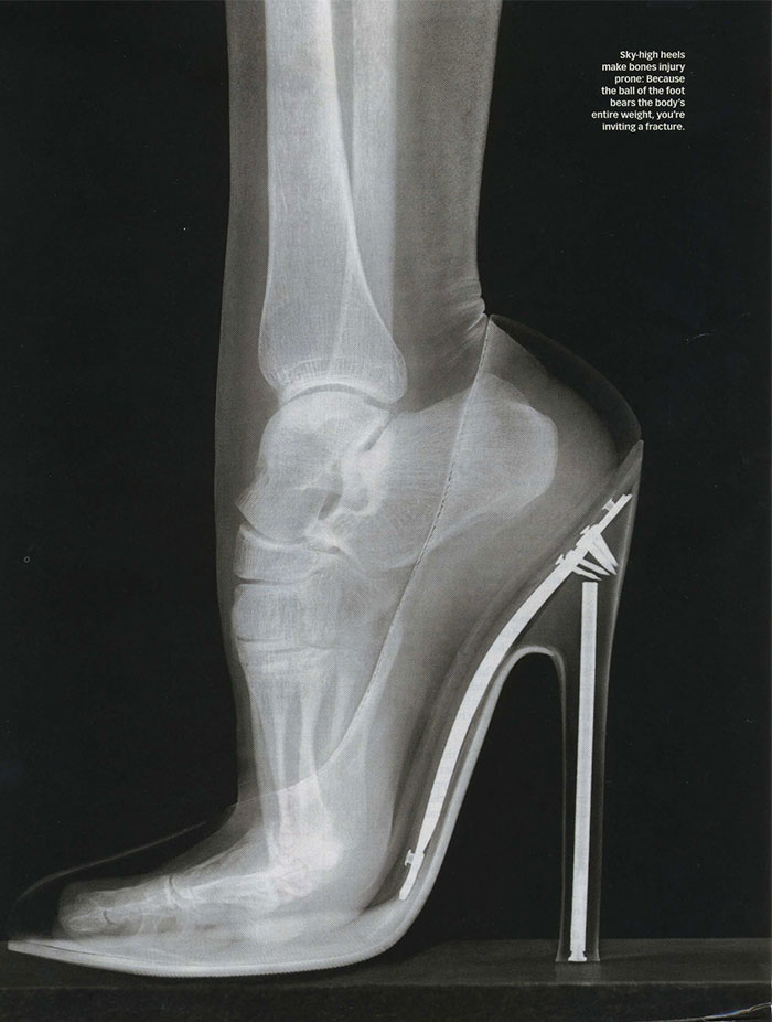 X-Ray Of A Foot In Stilettos