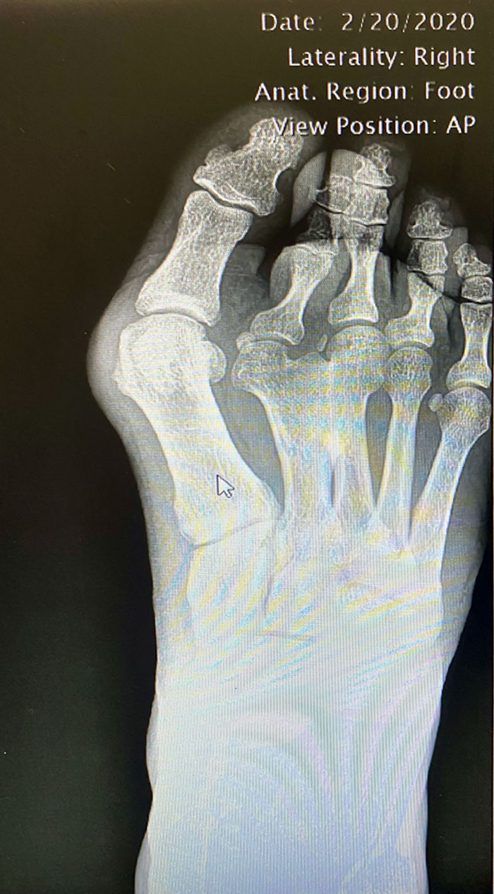 X-Ray Of My Bunion. I Thought It Was Interesting