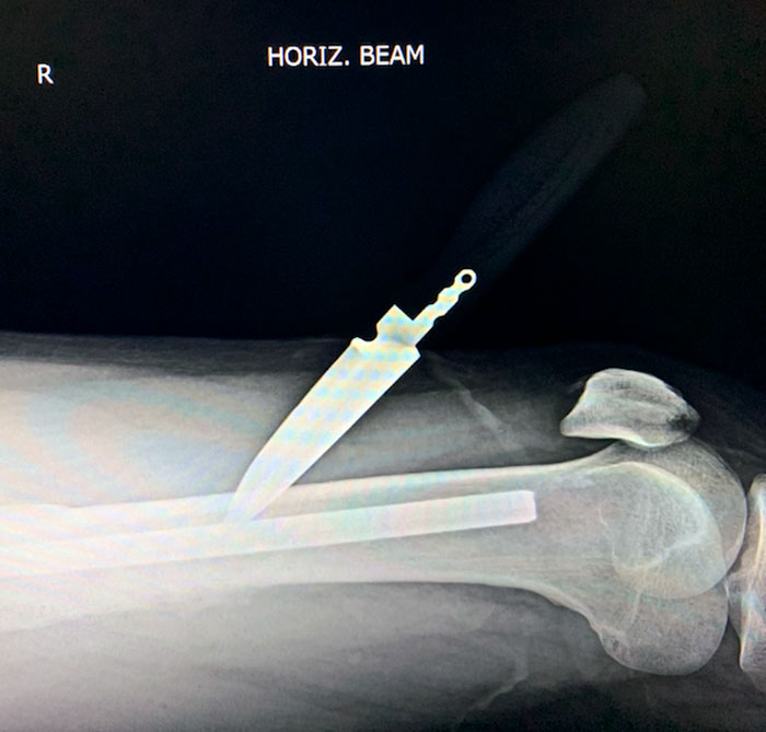 ED Patient From A While Ago Who Stabbed Himself In The Leg - AP Showed The Knife Sitting Around 2 cm Medially To The Femur