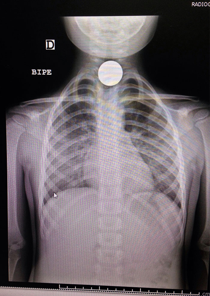The Little Girl Swallowed A Coin