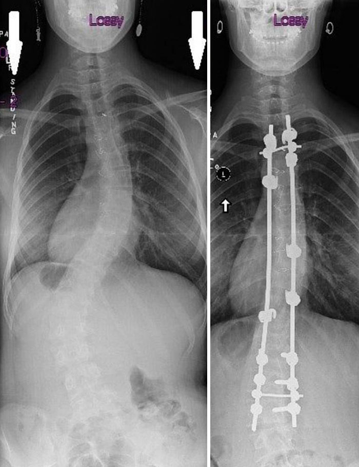 X-Rays Before And After Spinal Fusion Surgery For Scoliosis. I Had Surgery At 12 After The Curvature Continued Getting Worse Despite Interventions Being Taken