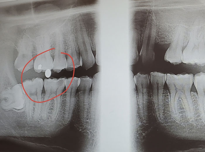 X-Ray From The Dentist Shows A BB From When I Got Shot In The Face About 15 Years Ago