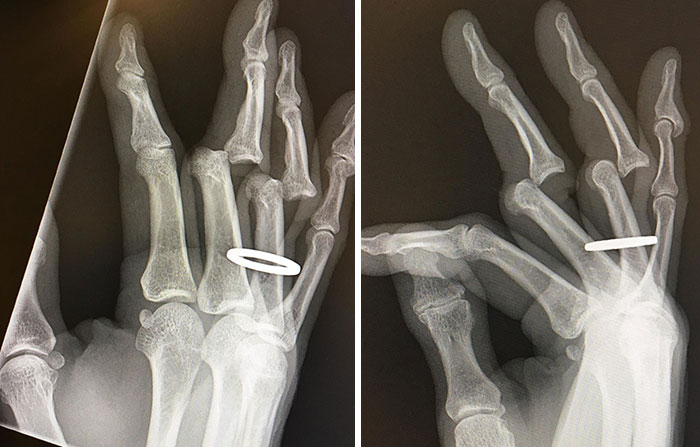 Just Received My X-Rays From Saturday’s Debacle. They Had To Cut My Ring Off Before Returning My Bones To Their Full Upright And Locked Position