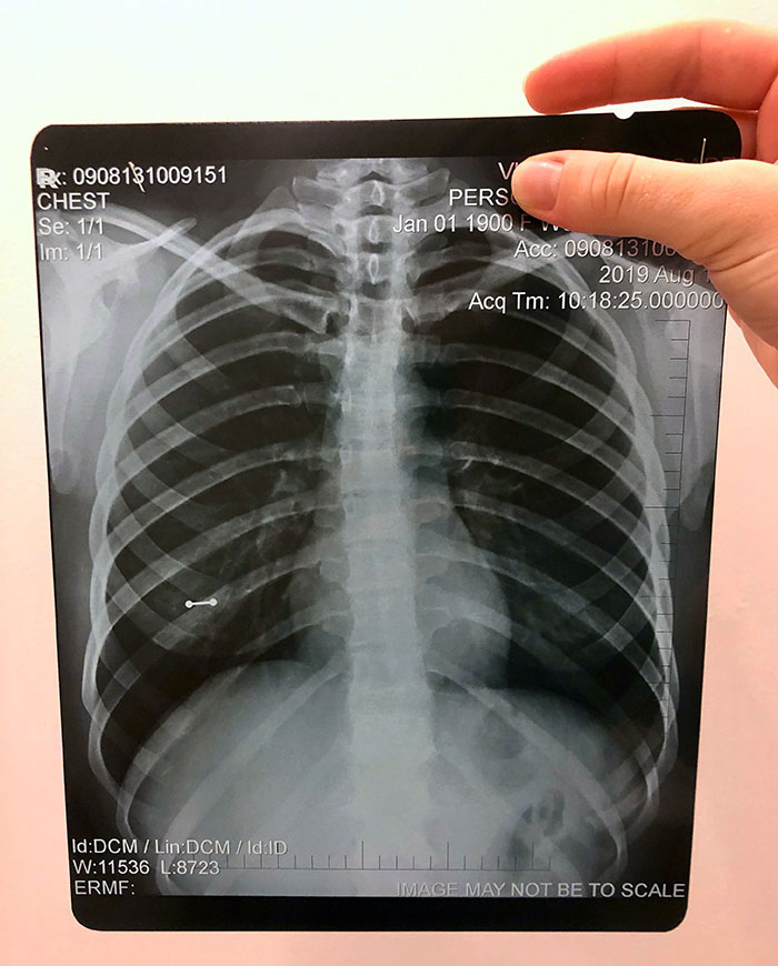 My Nipple Piercing On My Chest X-Ray